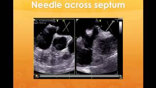 TOE in left atrial appendage assessment & the Watchman device