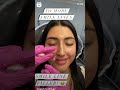 NEED SMILE LINE FILLER? 🤩💉