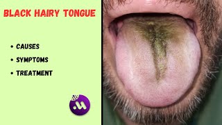 Black hairy tongue | Is it dangerous? | Causes, symptoms, treatment