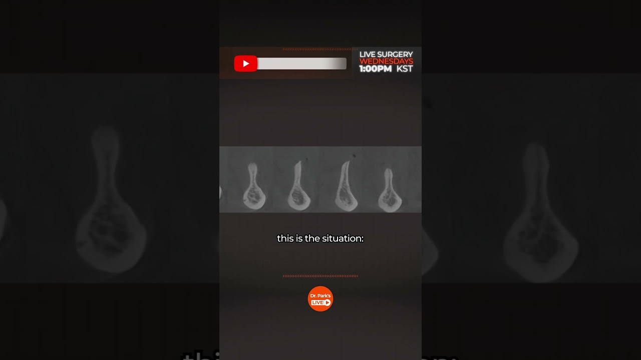 Atrophic Ridge Case I Full Mouth Rehabilitation Solution #ThinRidge #Fixedimplants #AtrophicRidge
