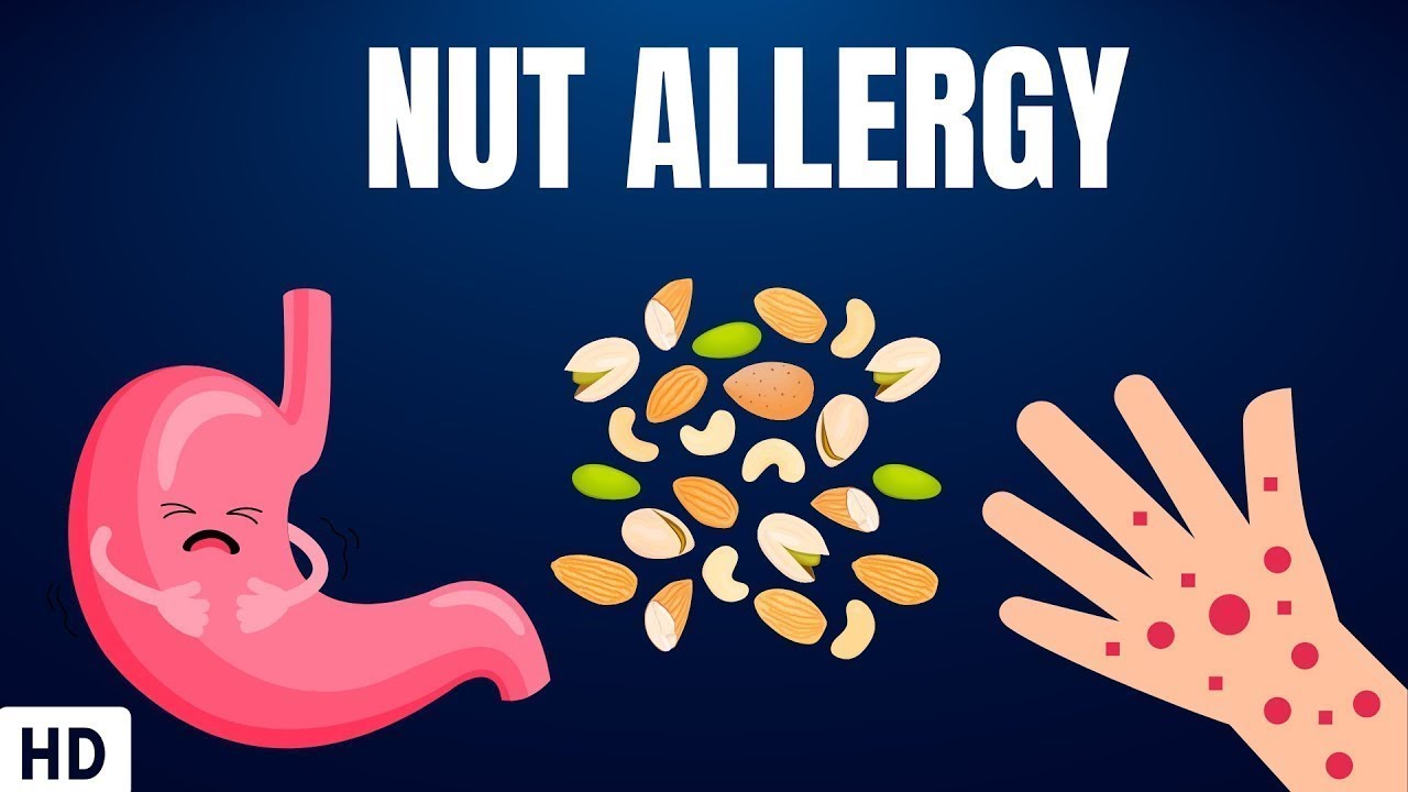 Nut Allergy: Everything You Need To Know