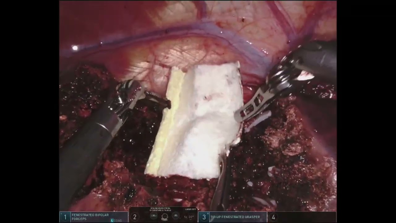 Robotic liver and rectal resection for rectal cancer with synchronous liver mestastasis