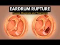 The Science Behind Eardrum Rupture: Explained in Simple Terms