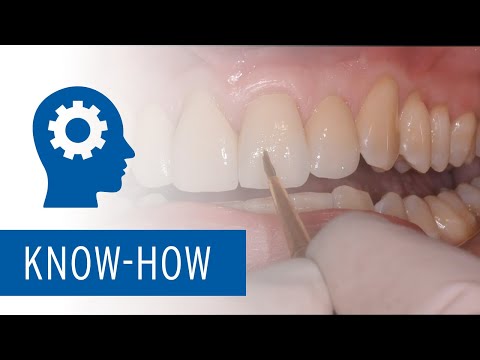 Use of different Zolid zirconia types in everyday dental practice