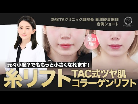切らないリフトで小顔が超小顔に!【糸リフト症例】