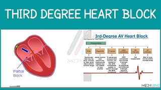 Third Degree Heart Block (Complete AV Block) | ECG Pattern, Causes & Management