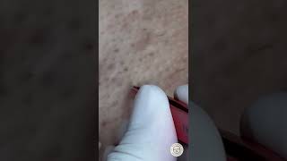 Download lagu Fast and Effective Ingrown Hair Removal Techniques #waxing #hardwax  #brazilian mp3