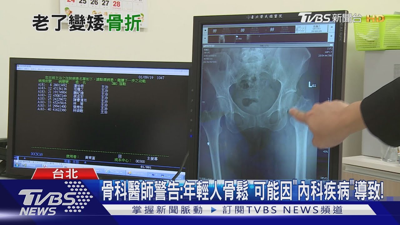 「年紀輕」骨質流失太嚴重發現 「多發性骨髓瘤」致這部位骨折