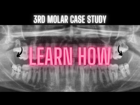Third Molar Impaction Video | Learn How