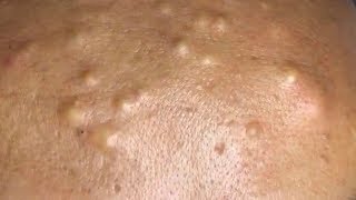 How To Remove Blackheads And Whiteheads On Face Easy #122 ✦ Dr Laelia ✦