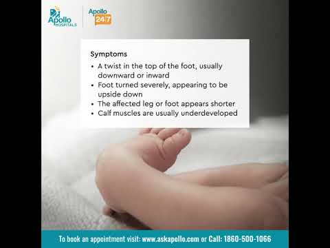 What is Club Foot? Does congenital clubfoot affect one or both feet? | Apollo Hospitals