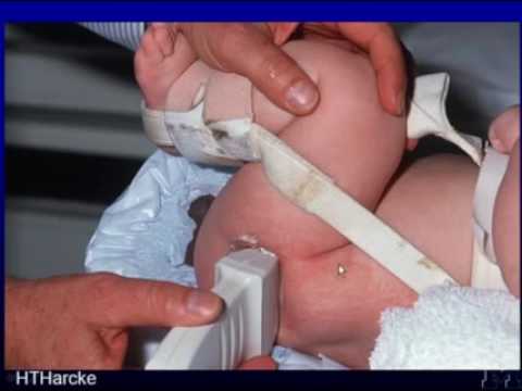 Sonography of the Pediatric Hip