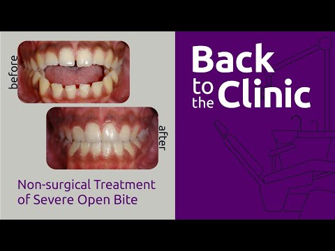 Non-surgical Treatment of Severe Open Bite - Back to the Clinic #004