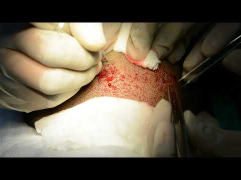 download lagu mp3 mp4 3500 Grafts Hair Transplant, download lagu 3500 Grafts Hair Transplant gratis, unduh video klip 3500 Grafts Hair Transplant