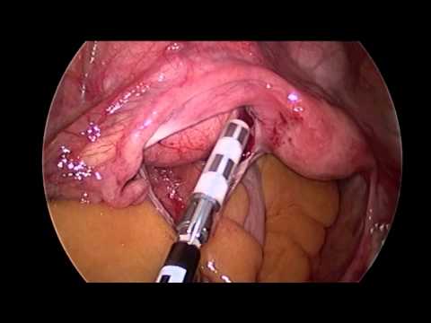 Myomectomy Single Site