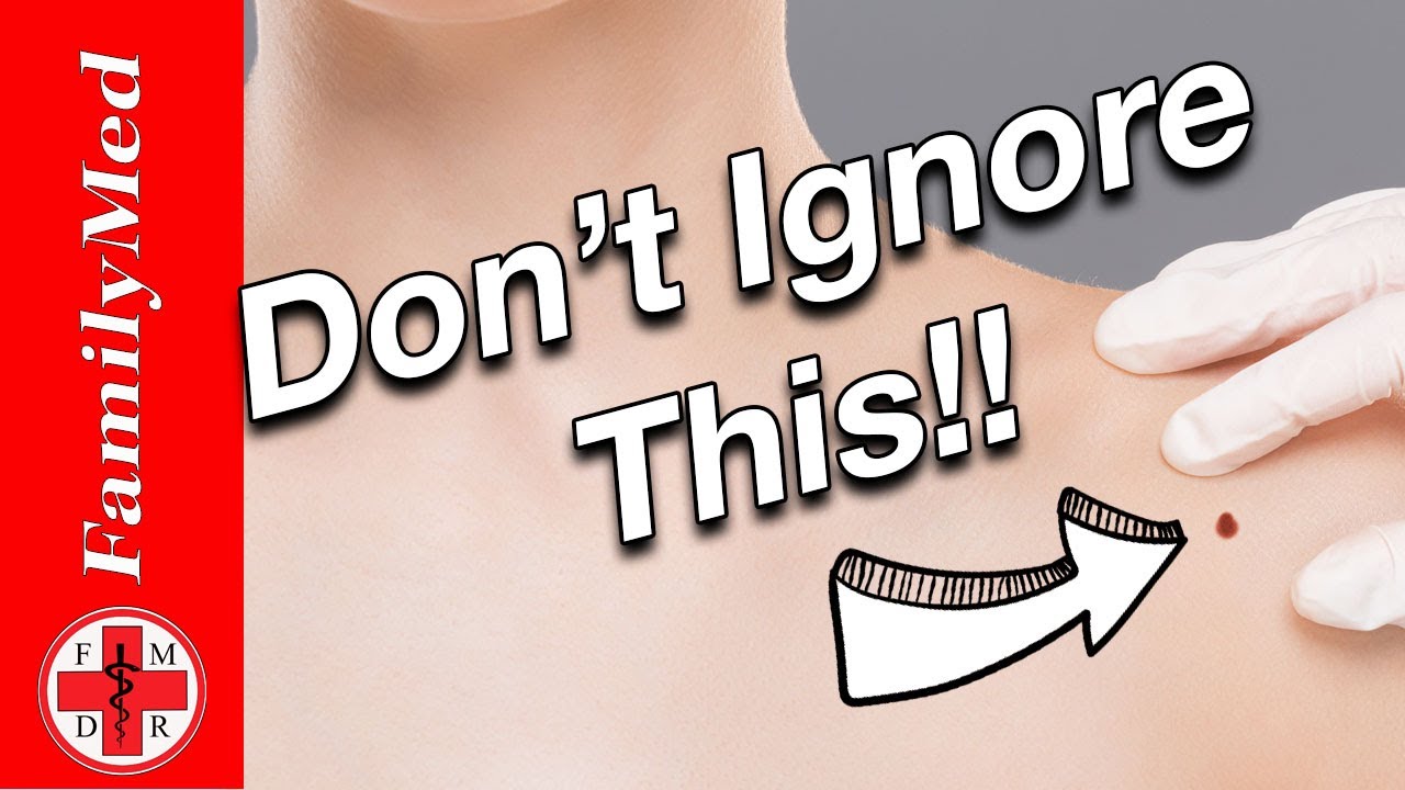 Catch Skin Cancer Early! Doctors Guide