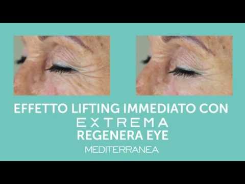 Che accettare a hypostases di occhi La cima di procedure affronta il ringiovanimento