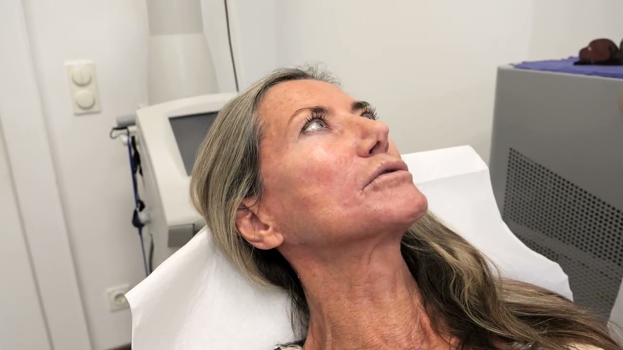Skin Booster Behandlung