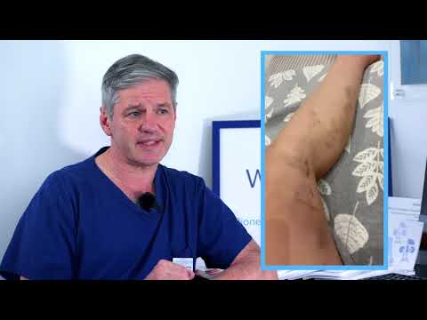 YouTube video about: Should I elevate my legs after sclerotherapy?