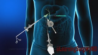 My Gallbladder Surgery Experience