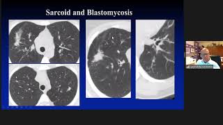 Oncological Imaging: Practical Approach - 'Mimics of Malignancy: Lung and pleura', by Dr Luba Frank