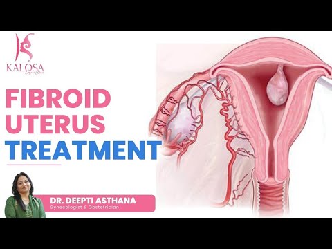 Uterine Fibroids कैसे Treat करें? | Uterine Fibroid Treatment Options in Hindi | Dr. Deepti Asthana