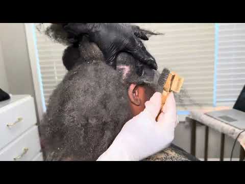 Seborrheic  dermatitis on a 4 month old sew in.