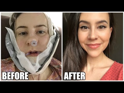 I Got Plastic Surgery in Korea || Before & After || Double Jaw Surgery Experience Part 3 Video