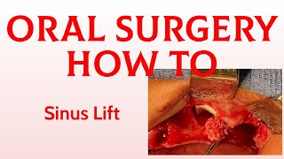 Oral Surgery How to: Lateral Window Sinus Lift (Caldwell Luc)