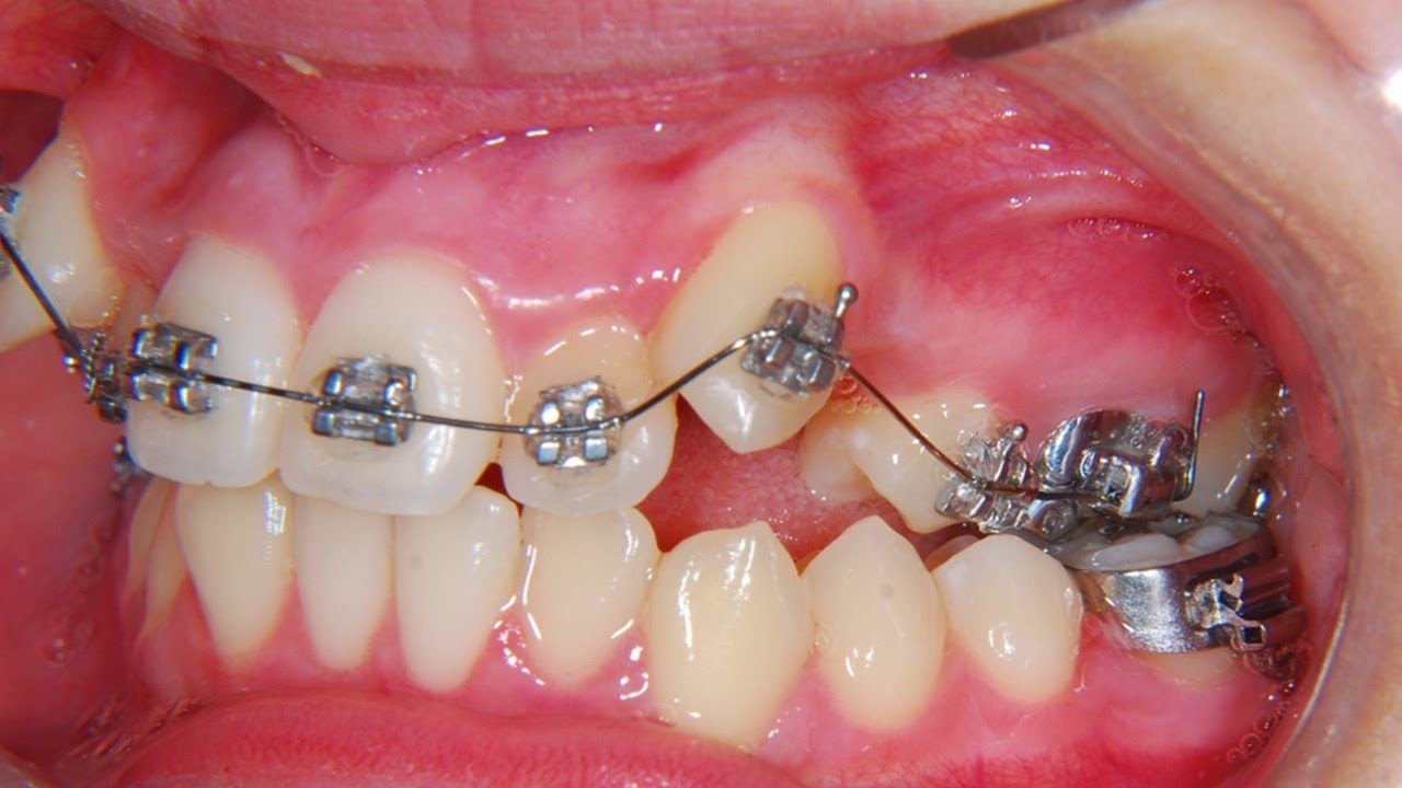 CANINOS MONTADOS Y APIÑAMIENTO SEVERO🦷! LA ORTODONCIA ES LA SOLUCIÓN! ANTES Y DESPUÉS ☝⏱1 AÑO!