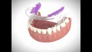 Inman Aligner - Hidden Braces