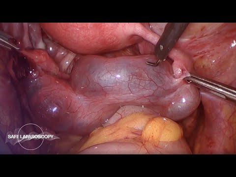 szklerotizáló intraductalis papilloma apokrin metaplasiával