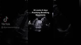 Download lagu 26 weeks 6 days 2D Ultrasound #jerbearimaging #ultrasound #baby mp3 Download lagu 26 weeks 6 days 2D Ultrasound #jerbearimaging #ultrasound #baby mp3