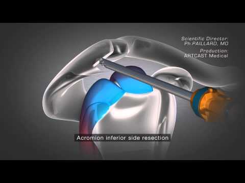 Shoulder Arthroscopy - Acromioplasty