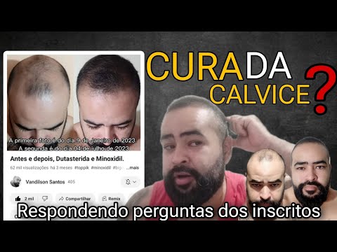 (Dutasterida e Minoxidil) Antes e depois Respondendo perguntas. E aí? Calvice tem cura?