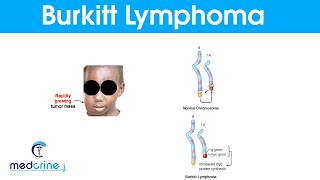 Burkitt's Lymphoma:Causes , Symptoms and Treatment