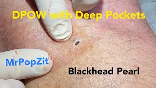 The Blackhead with deep pockets. DPOW blackhead pearl extraction on posterior “popliteal” knee .