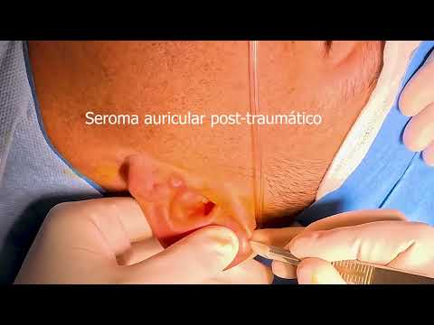 ¿Cómo evitar la oreja en coliflor?