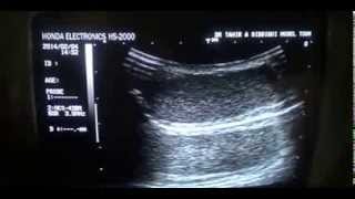 preview picture of video 'ECTOPIC inguinal region LT TESTIS'