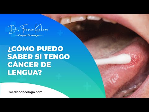 ¿Cómo Puedo Saber Si Tengo Cáncer De Lengua? | Dr. Franco Krakaur | Cirujano Oncólogo