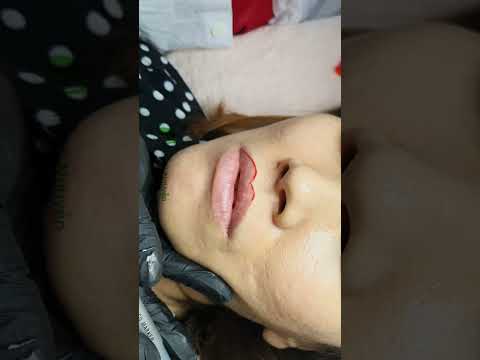 Cấy môi sinh học kỹ thuật mới, không sưng đau