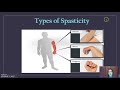 How Botox and splinting motor components can impact post-stoke patients