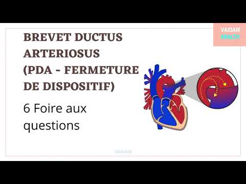 BREVET DUCTUS ARTERIOSUS (PDA - FERMETURE DE DISPOSITIF)