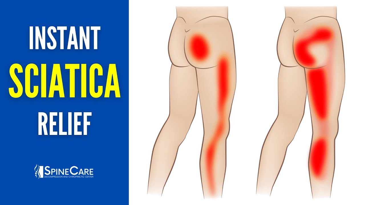 How to Relieve Sciatica Pain Instantly - Step-by-Step Exercises