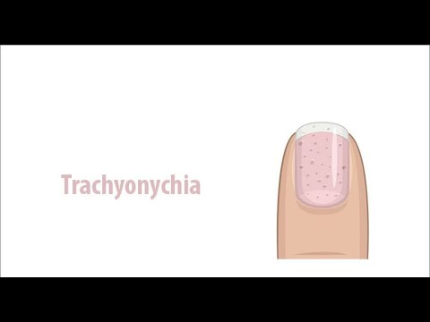 Trachyonychia or rough nails or sandpaper nails ; Definition, Causes, Symptoms, Diagnosis, Treatment