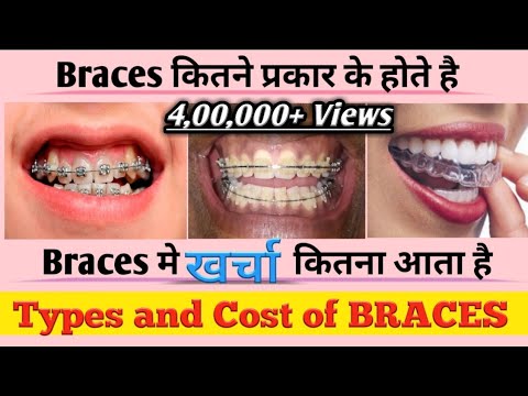 Dental Braces Kit - Teeth Aligners Latest Price, Manufacturers & Suppliers