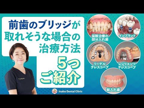 前歯のブリッジが取れそうな場合の治療方法5つご紹介