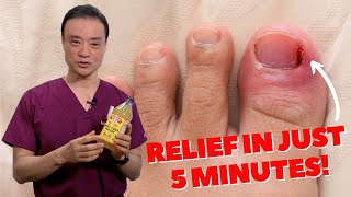6 HOME REMEDIES To Treat A PAINFUL Ingrown Nail | Dr. Kim