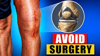 Avoid Total Knee Replacement Surgery