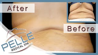 preview picture of video 'Laser Liposuction Bedford - Special Offer - Pelle Medical Spa'